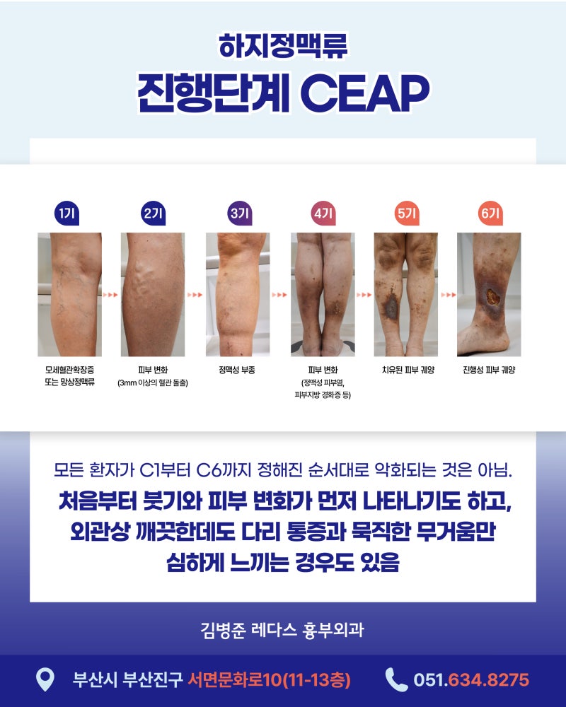 다리 실핏줄이 하지정맥류 1기? 초기 증상을 확인해보세요 사진 5