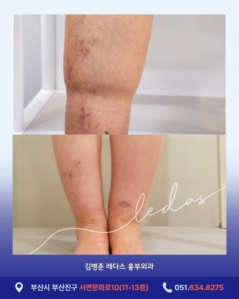 서면하지정맥병원 저녁마다 양말 자국, 다리가 붓고 무겁다면? 사진 4