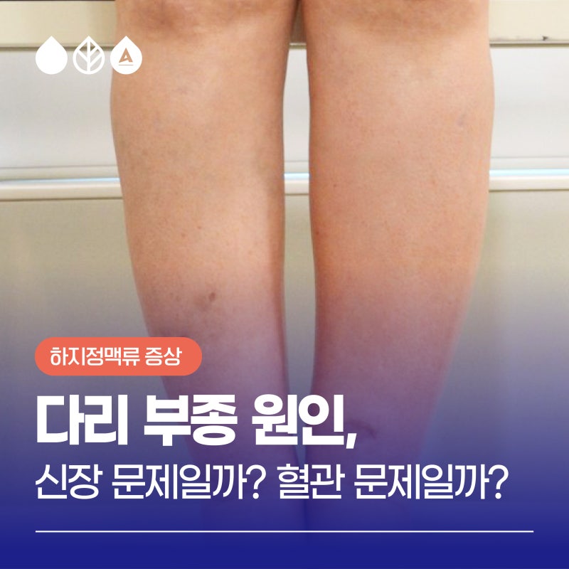 부산다리부종 원인, 신장 문제일까 혈관 문제일까? 구분하는 법